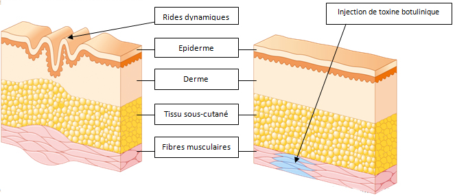 acide hyaluronique ou prend t-il effet